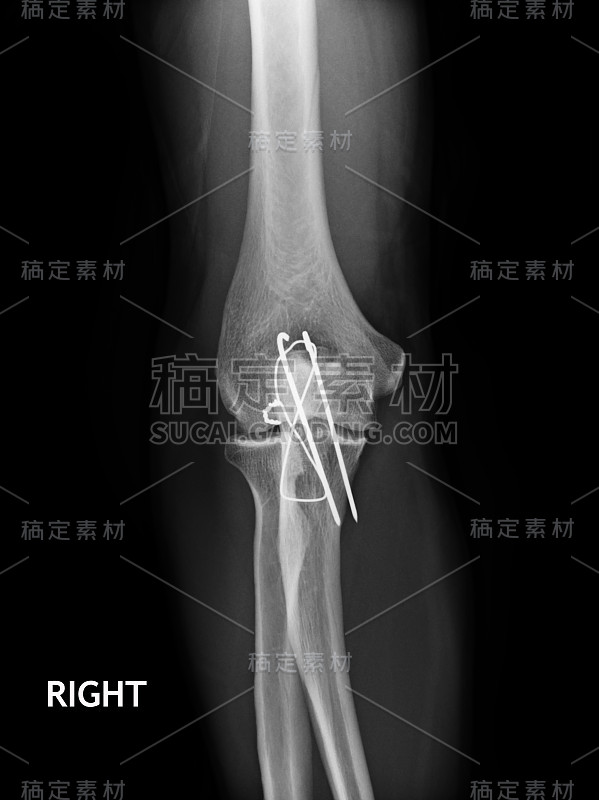 肘关节骨折，前臂x光片显示钢板和螺钉固定