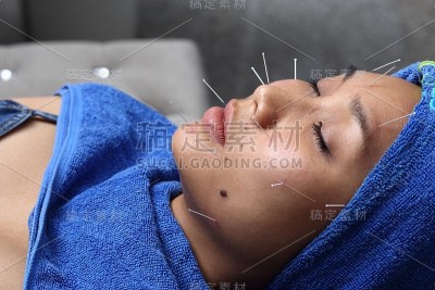 近手进行医学专业针灸治疗