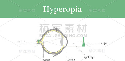 眼球插图。远视。