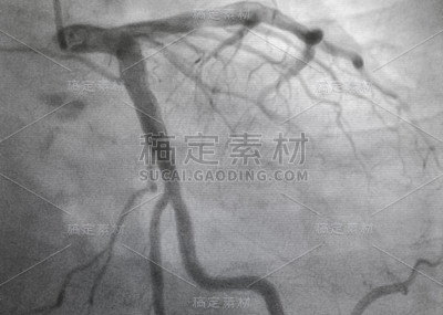冠状动脉造影。