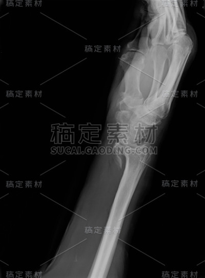 x光