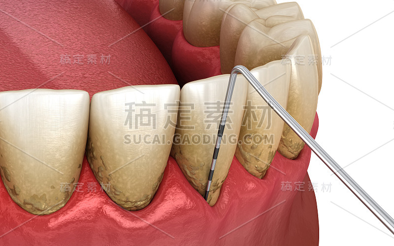 牙周炎测试，牙龈衰退过程。医用精准3D插图