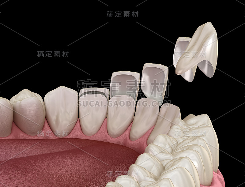 中切牙和侧切牙贴面安装程序。医学上准确的牙齿3D插图