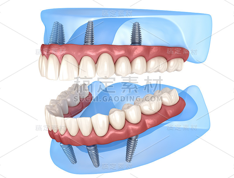 上颌、下颌骨全修复体，4个系统，种植体支持。医学上准确的人类牙齿和假牙的3D插图