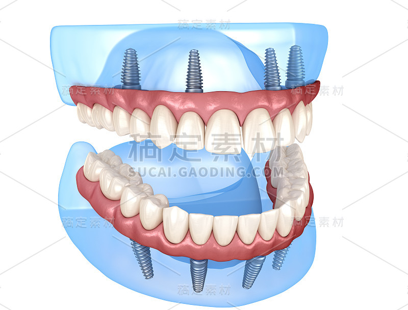 上颌、下颌骨全修复体，4个系统，种植体支持。医学上准确的人类牙齿和假牙的3D插图