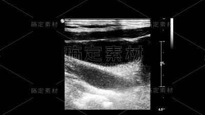 血管超声检查。