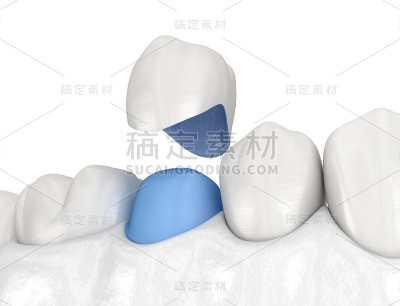 烤瓷冠放置在前磨牙上。医用精准3D插图