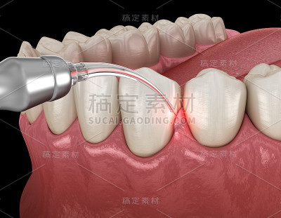 用激光矫正牙龈。医学上准确的牙齿3D插图