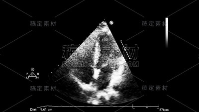 经食管超声检查心脏图像。