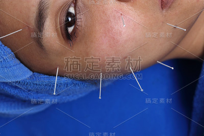 近手进行医学专业针灸治疗