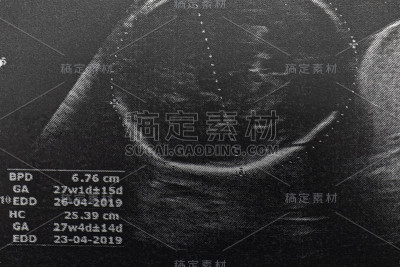 孕妇胎儿超声检查，医生通过超声读取孕妇检测结果。