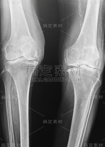 膝关节X线图像。
