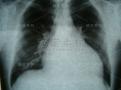 x光片，胸部，心力衰竭