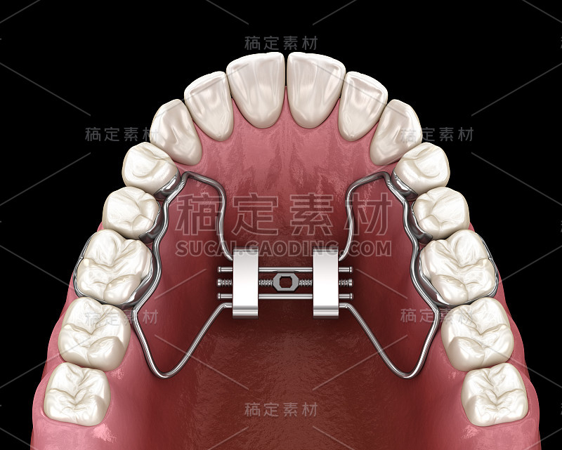 快速腭扩展。医学上准确的牙齿3D插图