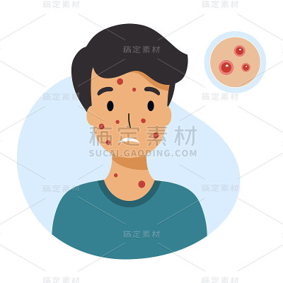 有水痘症状的男孩皮疹和丘疹。矢量字符在平面风格。