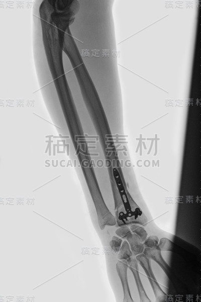断了的手