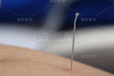 近手进行医学专业针灸治疗