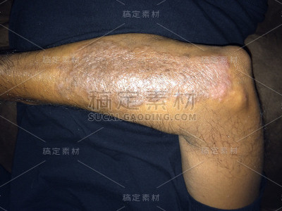 牛皮癣