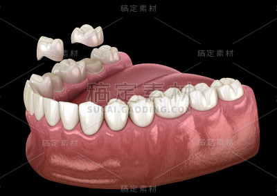 烤瓷冠放置在前磨牙和磨牙上。医用精准3D插图