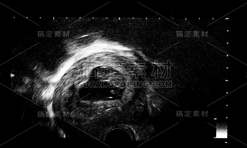 胎儿的超声波检查