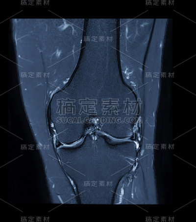 MRI膝关节成像或磁共振膝关节搅拌技术冠状面脂肪抑制。