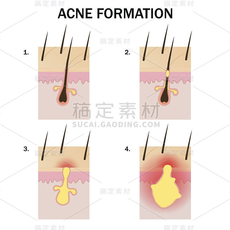 形成的粉刺