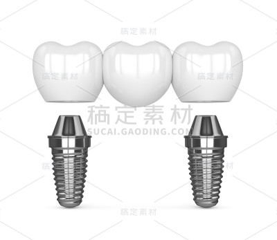 种植体与牙桥的3d渲染