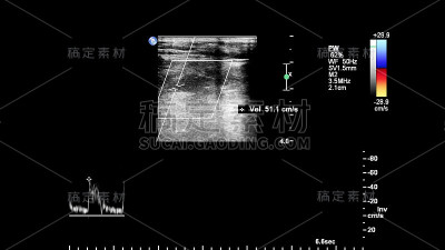 血管超声检查。
