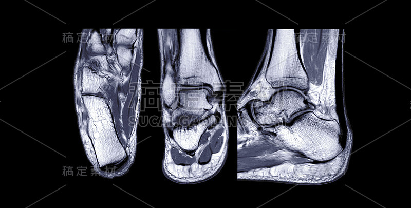 比较MRI踝关节轴位、冠状位和矢状位t2对肌腱损伤的诊断价值。