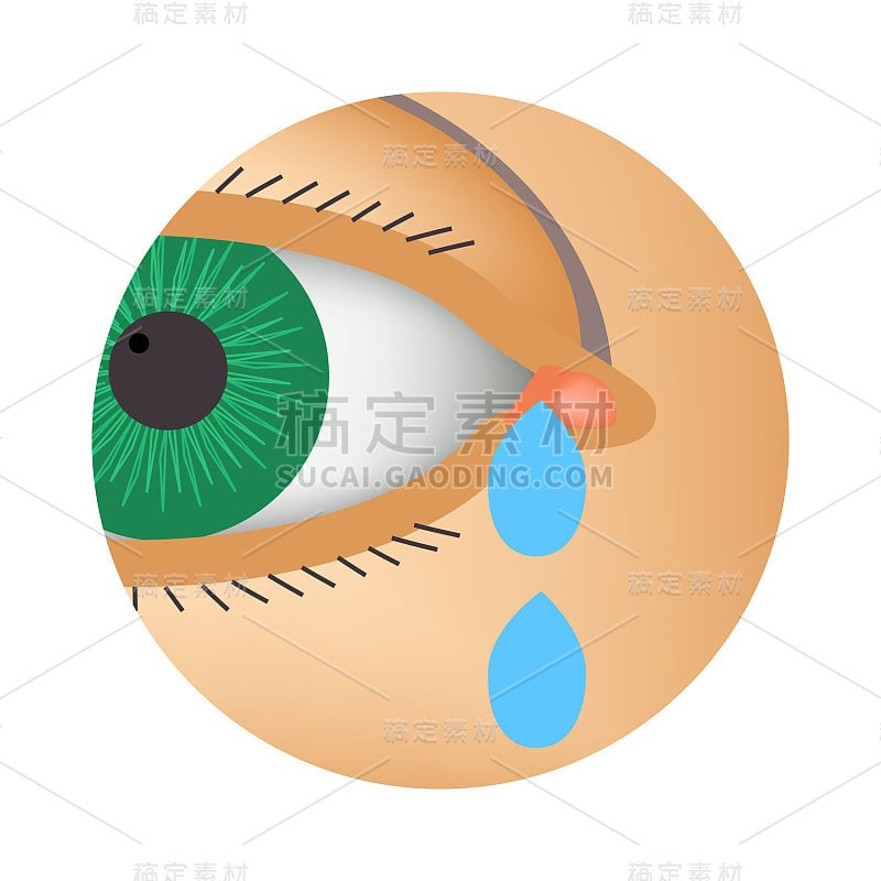 眼泪从眼睛涌出。结膜炎的症状，过敏，眼睛发炎。眼睛浇水图标。信息图。矢量插图在孤立的背景。