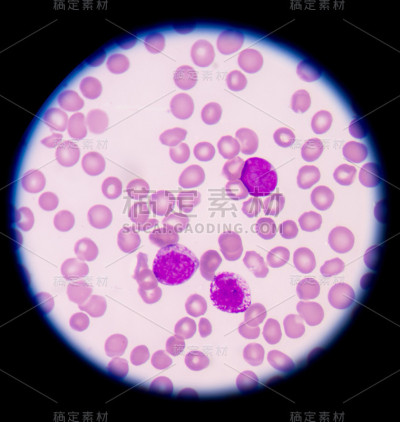急性骨髓性白血病(AML)