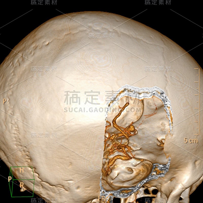 三维计算机断层血管造影(CTA)重建大脑