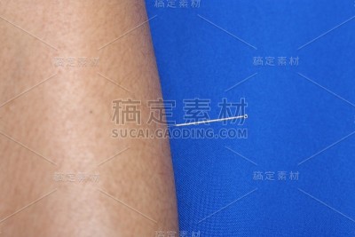 近手进行医学专业针灸治疗