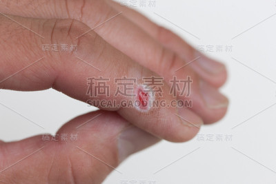 治疗时指尖受伤。