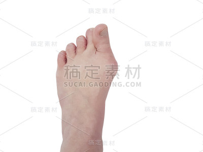 拇外翻，腿，孤立于白色，疼痛的关节