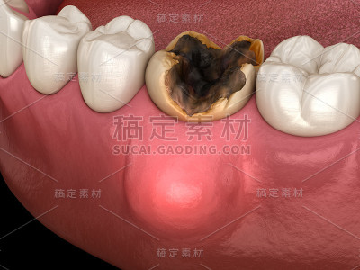 牙周炎和牙龈发炎。医学上准确的牙科3D插图