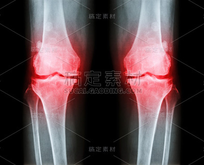 两膝骨关节炎