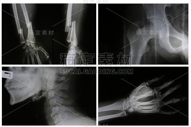 x射线照片收集