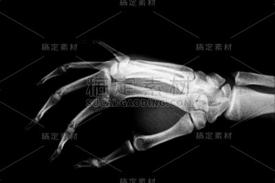 人类双手的x光图像