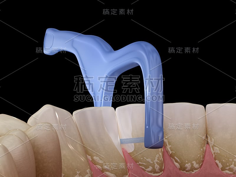 口腔卫生:用牙签剔牙。医学上准确的牙科3D插图