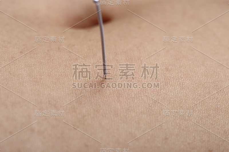 近手进行医学专业针灸治疗