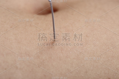近手进行医学专业针灸治疗