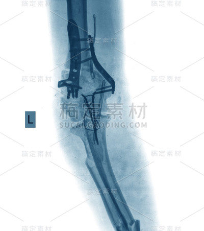 带螺丝断臂