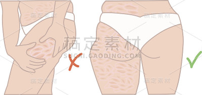 脂肪团前后的结果。