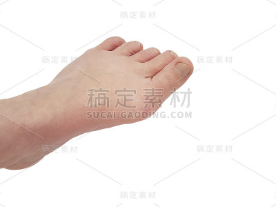 拇外翻，两腿孤立于白色疼痛关节上