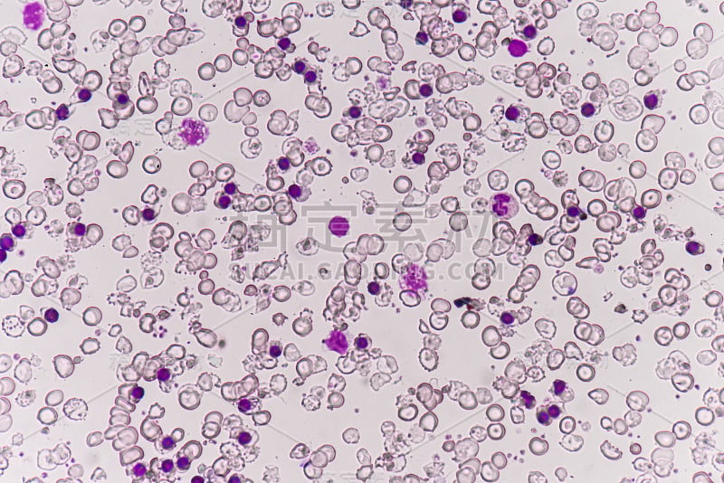 血液涂片中的红细胞异常。