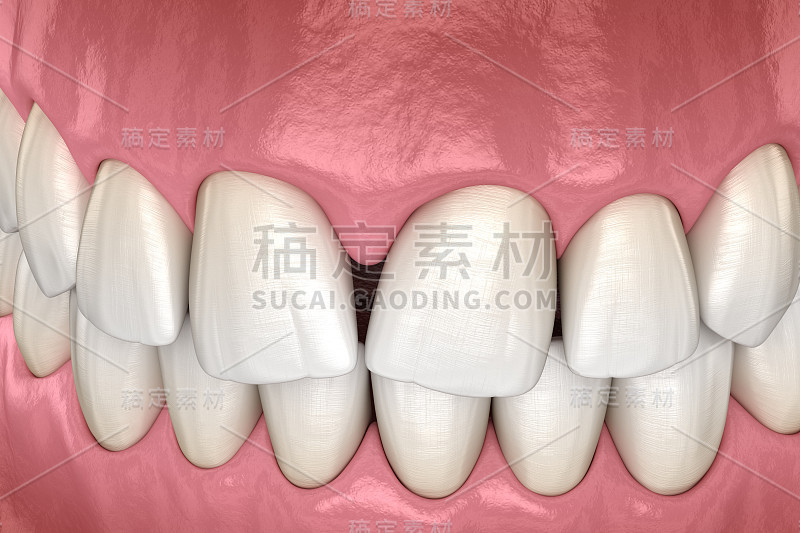 中切牙牙缝会聚。牙科功能障碍3D插图概念