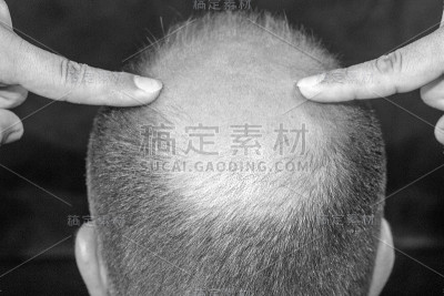 男性脱发/秃顶