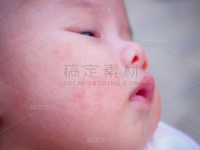 新生儿面部过敏