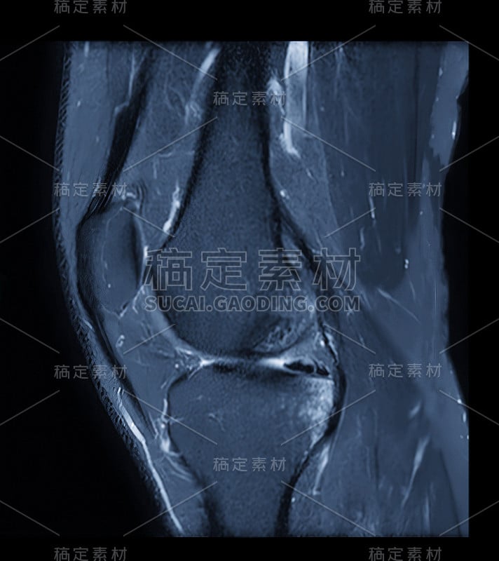 MRI膝关节成像或磁共振膝关节搅拌技术矢状面脂肪抑制。